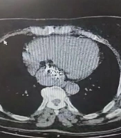 Detection of a Gossypiboma as a Retrocardiac Mass in a Female Patient with a History of Coronary Artery Bypass Graft