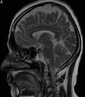 Acute Neurological Deficits Post Coronary Angiography: A Case Report of Contrast Induced Neurotoxicity and Its Clinical Implications