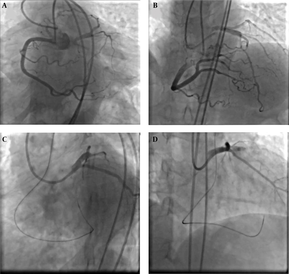 Dual access injection showed left main chronic total occlusion (LM CTO) which was filled via retrograde approach through right coronary artery (A, B), then left main-left anterior descending artery (LM-LAD) was wired via conus branch of right coronary artery with black SION (C), then percutaneous coronary intervention (PCI) on LM-LAD was done (D). Dual access injection showed left main chronic total occlusion (LM CTO) which was filled via retrograde approach through right coronary artery (A, B), then left main-left anterior descending artery (LM-LAD) was wired via conus branch of right coronary artery with black SION (C), then percutaneous coronary intervention (PCI) on LM-LAD was done (D).