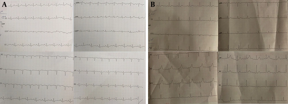 Follow-up electrocardiograms at 3 months after successful retrograde revascularization of left main coronary artery chronic total occlusion (LMCA CTO). Case 1: Three-month ECG showing normal sinus rhythm with resolution of previous lateral ST-T changes and absence of ischemic abnormalities following retrograde PCI via the conus branch collateral (A). Case 2: Three-month ECG demonstrating stable sinus rhythm and restoration of normal repolarization pattern after retrograde LMCA CTO PCI performed through septal collaterals (B). Follow-up electrocardiograms at 3 months after successful retrograde revascularization of left main coronary artery chronic total occlusion (LMCA CTO). Case 1: Three-month ECG showing normal sinus rhythm with resolution of previous lateral ST-T changes and absence of ischemic abnormalities following retrograde PCI via the conus branch collateral (A). Case 2: Three-month ECG demonstrating stable sinus rhythm and restoration of normal repolarization pattern after retrograde LMCA CTO PCI performed through septal collaterals (B).