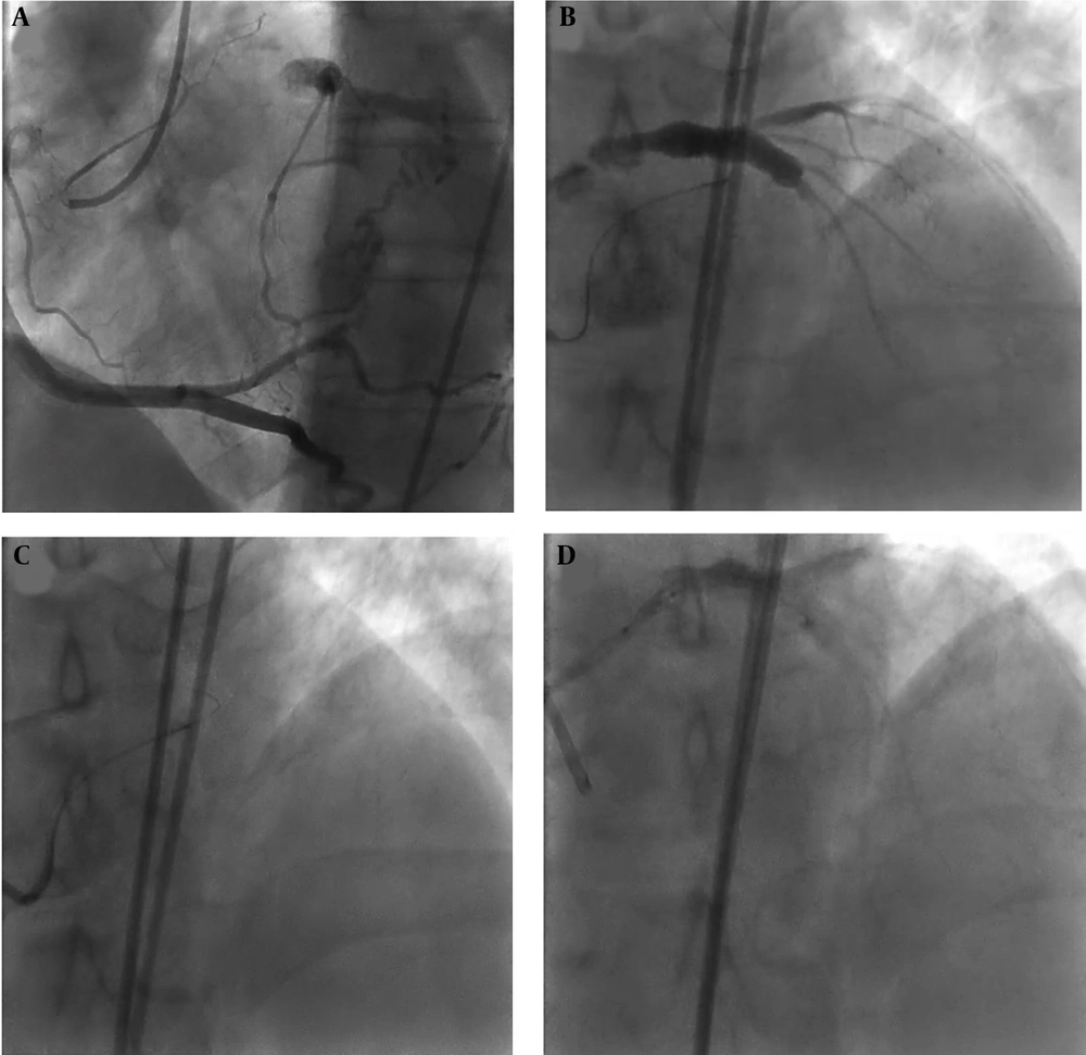 Dual access injection showed left main chronic total occlusion (LM CTO) which was filled via retrograde approach through right coronary artery (A, B), then left main-left anterior descending artery (LM-LAD) was wired via septal branches of right coronary artery with black SION (C), then percutaneous coronary intervention (PCI) on LM-LAD was done (D). Dual access injection showed left main chronic total occlusion (LM CTO) which was filled via retrograde approach through right coronary artery (A, B), then left main-left anterior descending artery (LM-LAD) was wired via septal branches of right coronary artery with black SION (C), then percutaneous coronary intervention (PCI) on LM-LAD was done (D).