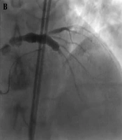 Retrograde Revascularization of Left Main Coronary Chronic Total Occlusion: Distinct Roles of Conus Branch and Septal Collaterals: Two Case Report
