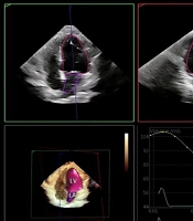 3D Echocardiographic Normal Values of LV Volumes and EF in Iranian Populations
