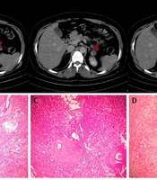 Hypokalemic Quadriparesis as the Initial Manifestation of Primary Aldosteronism: A Case Report