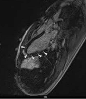 Concurrent Acute Myocarditis in Monozygotic Twins: A Case Report with Similar CMR Findings