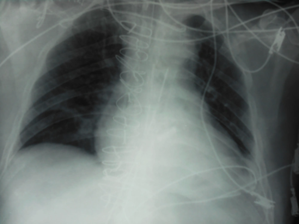 Baseline Chest X-ray Baseline Chest X-ray