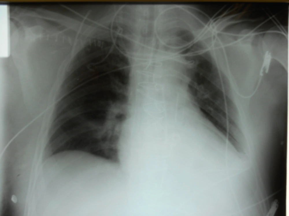 Chest X-ray During Hypoxemia Chest X-ray During Hypoxemia