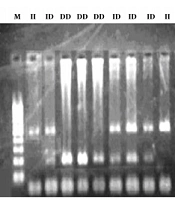 Distribution of DD Genotype of Angiotensin-Converting Enzyme Gene and Its Correlation with Diabetic Retinopathy
