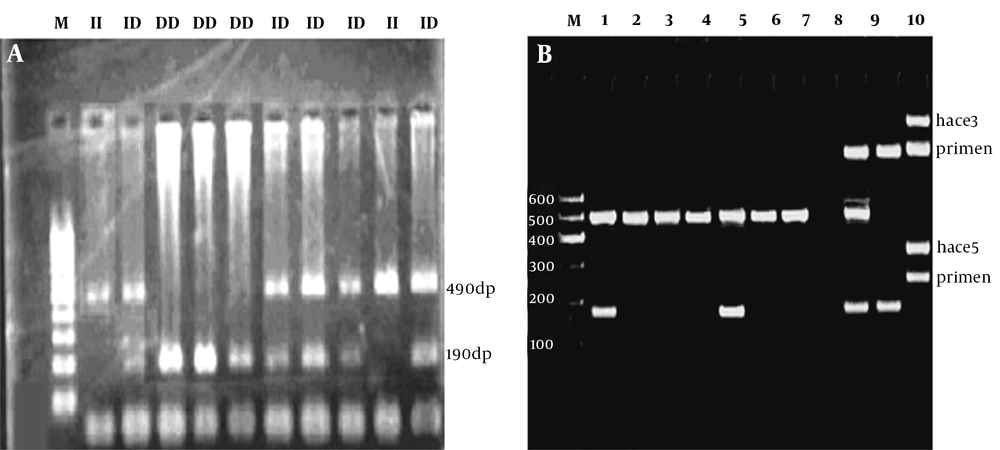 The PCR amplification results to determine <i>ACE</i> Genotypes. A, <i>ACE</i> I/D deletion polymorphism is analyzed in this figure (M: 100 - 1000 bp Thermo Fisher Geneuler (the same ladder is used for both A and B); II: homozygous; ID heterozygous; DD homozygous; B, using a primer specific for insertion could incorrectly assign the DD genotype to DI samples. Using the hace3 primer pair, the lanes 1 through 6 are determined to be DD. These lanes are followed by standards for DD, blank control, DI, and II (lanes 7, 8, 9, and 10, respectively). Lane 9 is a DI standard, which shows the I band in comparison with preferential amplification of the D band; the faint line below the band is a presumed hetero-duplex band. The same samples, which are amplified with the hace5 primer pair, are shown at the bottom. These samples are able to recognize the insertion specific sequences. In lane 5, there is a sample, which was previously misclassified as DD. The PCR amplification results to determine <i>ACE</i> Genotypes. A, <i>ACE</i> I/D deletion polymorphism is analyzed in this figure (M: 100 - 1000 bp Thermo Fisher Geneuler (the same ladder is used for both A and B); II: homozygous; ID heterozygous; DD homozygous; B, using a primer specific for insertion could incorrectly assign the DD genotype to DI samples. Using the hace3 primer pair, the lanes 1 through 6 are determined to be DD. These lanes are followed by standards for DD, blank control, DI, and II (lanes 7, 8, 9, and 10, respectively). Lane 9 is a DI standard, which shows the I band in comparison with preferential amplification of the D band; the faint line below the band is a presumed hetero-duplex band. The same samples, which are amplified with the hace5 primer pair, are shown at the bottom. These samples are able to recognize the insertion specific sequences. In lane 5, there is a sample, which was previously misclassified as DD.