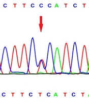 Circadian Rhythm Gene CLOCK Polymorphisms and the Risk of Schizophrenia Among Iranian Patients