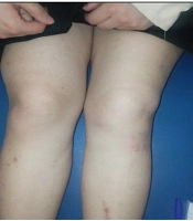 Improvement of Pain, Edema, and Knee Giving Way in Intermittent Hydrarthrosis Following Mobilization with Movement Techniques: A Case Report