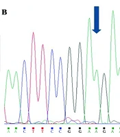 Absence of Pathogenic INSR Variants p.Arg1201Trp and p.Phe409Val in Ovarian Granulosa Cells of Iranian Women with Polyendocrine Metabolic Ovarian Syndrome