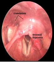 Cover image of the article: Prevalence and Correlation of Laryngopharyngeal Reflux in Females with Vitamin D Deficiency in a Multi-Specialty Polyclinic in New Delhi, India