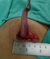 Minilaparotomy Cholecystectomy: A Forgotten Art in Laparoscopic Cholecystectomy Era (Our Experience from a Peripheral Hospital in North India)