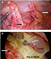 Subhepatic Appendicitis in North-East India: A Case Series Analysis and Review of Literature