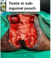 Fournier’s Gangrene: A Novel Approach and Pushing the Envelope to a Case of Abdominoperineal Necrotizing Soft Tissue Infection in Peripheral Hospital Setup and Review of Literature