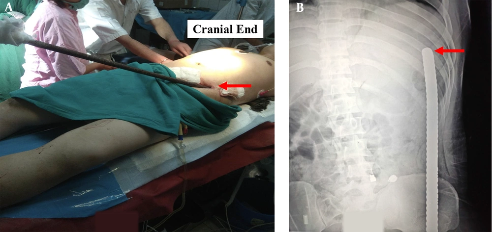A, Picture demonstrating the iron rod in situ, the red solid arrow marking the entry wound; B, X ray abdomen and chest with the red solid arrow marking the tip of the foreign body. A, Picture demonstrating the iron rod in situ, the red solid arrow marking the entry wound; B, X ray abdomen and chest with the red solid arrow marking the tip of the foreign body.