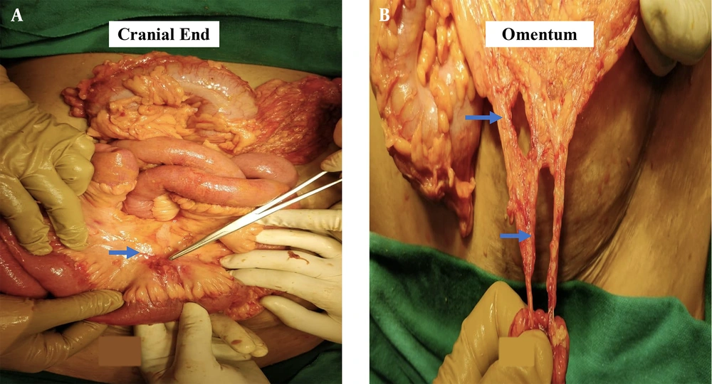 A, Intra-operative picture showing the exposed bowel loops with the blue arrow indicating the mesenteric tear; B, Intra-operative picture demonstrating the omental tears with blue arrows. A, Intra-operative picture showing the exposed bowel loops with the blue arrow indicating the mesenteric tear; B, Intra-operative picture demonstrating the omental tears with blue arrows.