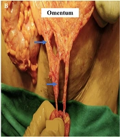 Cover image of the article: Abdomino-Thoracic Impalement: Challenges and Management in Remote Set up in North-East India