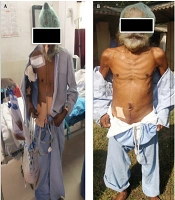 Mesodiverticular Band with Meckel’s Enterolith Caused Acute Small Bowel Obstruction and Perforation: A Case Report and Review of Literature
