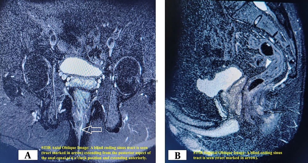 (A) STIR axial oblique image: A blind-ending sinus tract is seen (tract marked in arrow) extending from the posterior aspect of the anal canal at the 6 o’clock position and extending anteriorly. (B) STIR sagittal oblique image: A blind-ending sinus tract is seen (tract marked in arrow). (A) STIR axial oblique image: A blind-ending sinus tract is seen (tract marked in arrow) extending from the posterior aspect of the anal canal at the 6 o’clock position and extending anteriorly. (B) STIR sagittal oblique image: A blind-ending sinus tract is seen (tract marked in arrow).