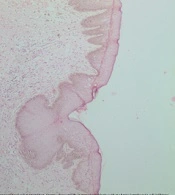 Gluteal Hidradenitis Suppurativa: A Case for Collaboration
