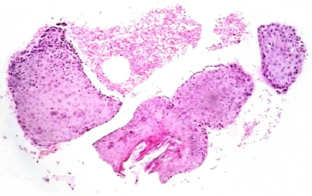 Microscopic view of mucosal lesion Microscopic view of mucosal lesion