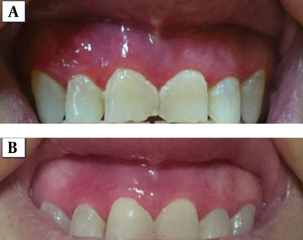 Comparison of the patient's gingiva before (A) and after (B) treatment Comparison of the patient's gingiva before (A) and after (B) treatment
