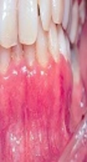 Cover image of the article: A Challenging in Diagnosis of Mucous Membrane Pemphigoid with Desquamative Gingivitis Presentation: A Case Report