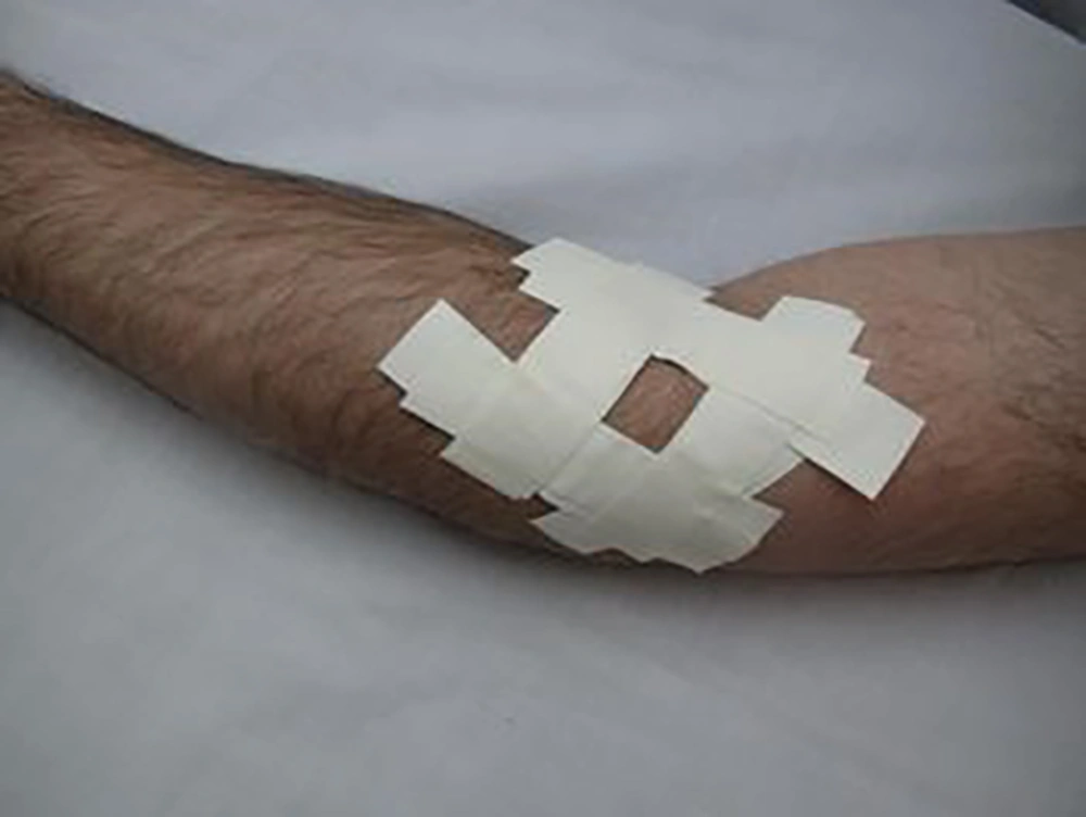 Non-elastic taping technique (TT) used in this study Non-elastic taping technique (TT) used in this study