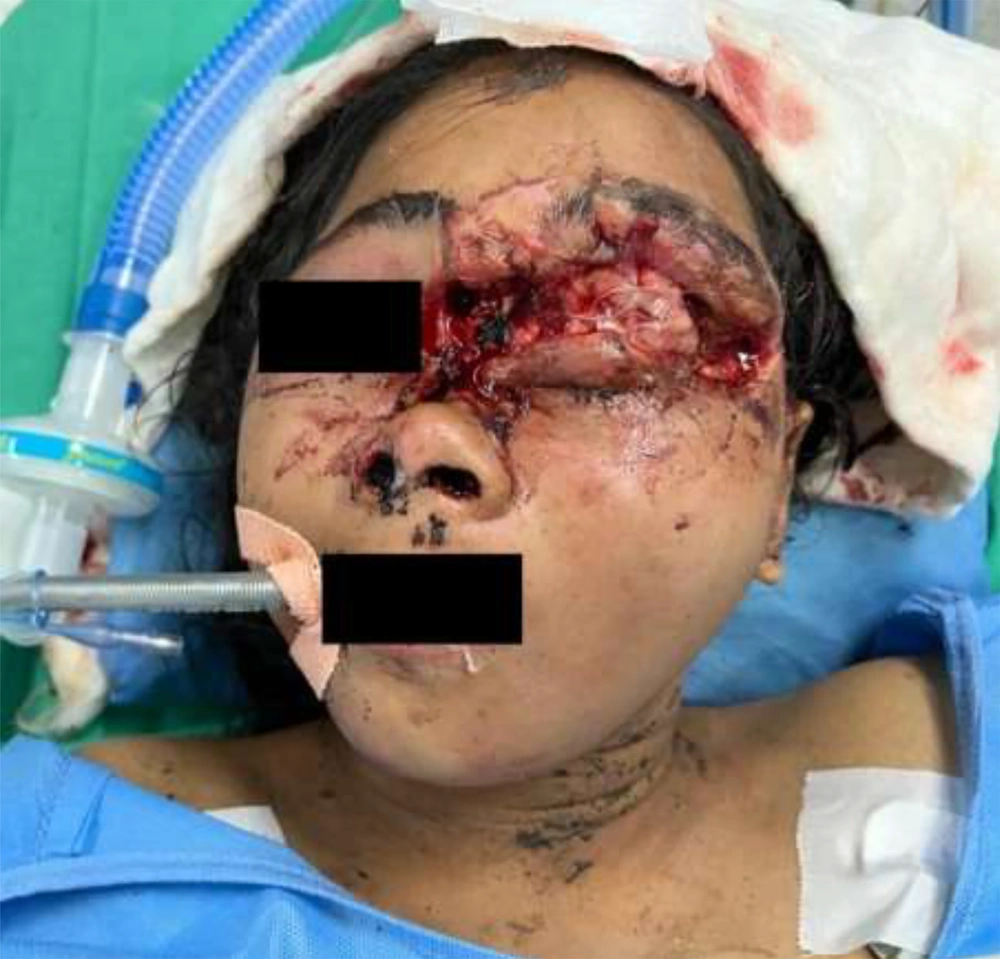 Showing the degloving injury over the forehead, left eyelid, and root of the nose Showing the degloving injury over the forehead, left eyelid, and root of the nose