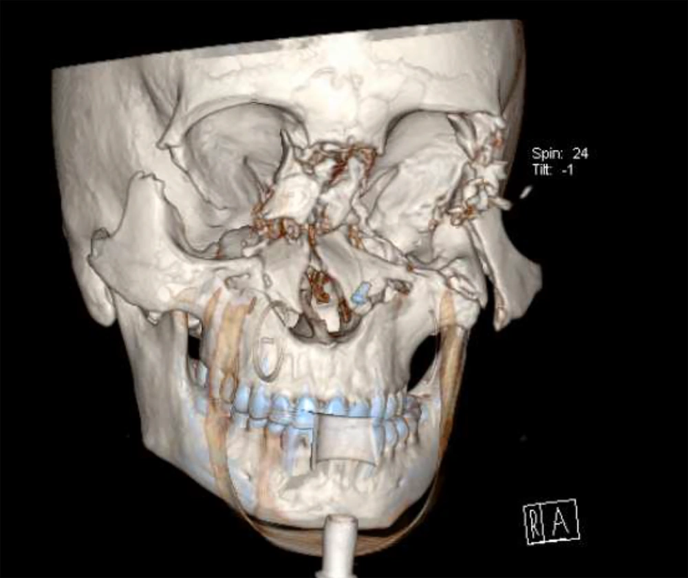 Non-contrast computerized tomography scan showing the pan-fascial fracture Non-contrast computerized tomography scan showing the pan-fascial fracture