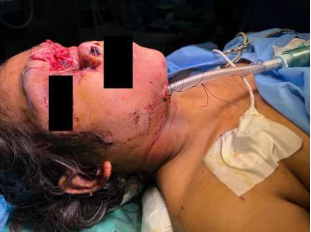 Showing the submental intubation Showing the submental intubation