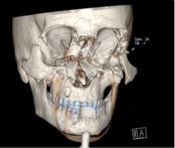 Anesthetic Management of Difficult Airway Due to Maxillofacial Trauma in a Pregnant Patient Requiring Submental Intubation: A Case Report