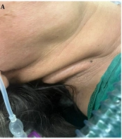 Anesthesia Management in an NF1 Patient with Type 1 Diabetes: A Case Report