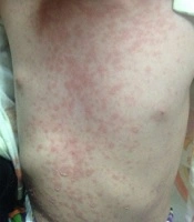Toxic Epidermal Necrolysis Syndrome Following Single-Dose Diclofenac Suppository, A Case Report