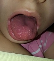 Aseptic Meningitis, As the First Manifestation of Kawasaki Disease: A Case Report