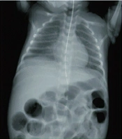 The Impact of Maternal Breast Milk in Preventing Necrotizing Enterocolitis: A Narrative Review