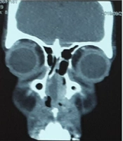 An Unusual Case of Nasal Septal Hematoma Caused by Local Dental Anesthesia in a 15-Year-Old Girl