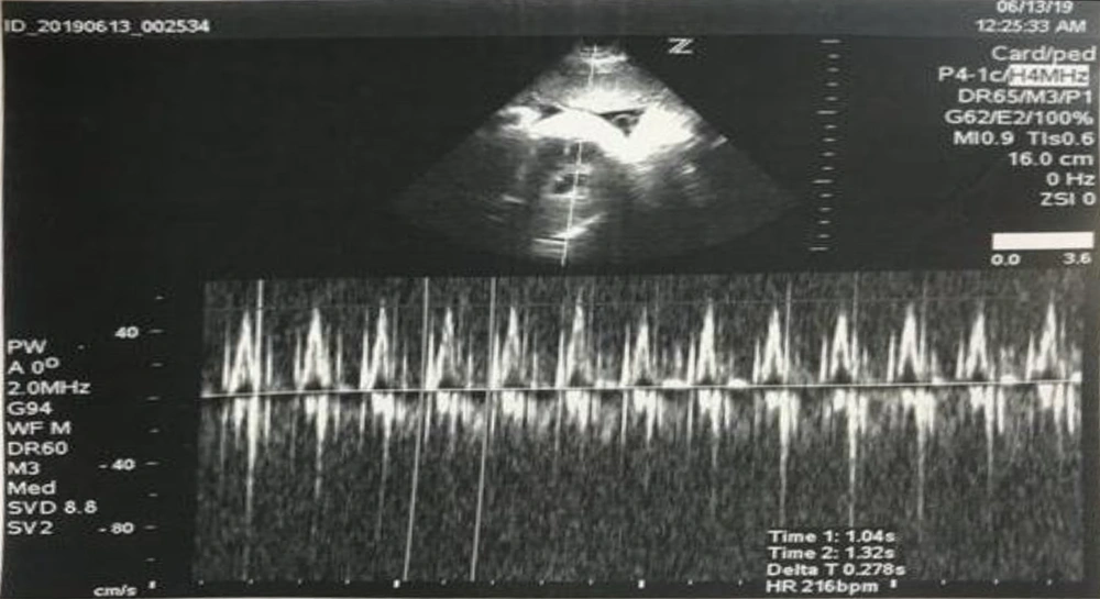 Normal heart structure without cardiomegaly and fetal heart rate at 235 beats/min. Also, relationship between atrial and vetricular contractility 1:1 and short RP interval. Normal heart structure without cardiomegaly and fetal heart rate at 235 beats/min. Also, relationship between atrial and vetricular contractility 1:1 and short RP interval.