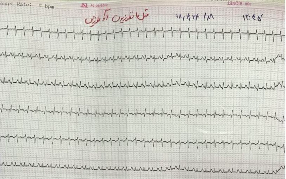 At 18 hours of birth, the HR was 230-240 beats/min which confirmed the SVT; AVNRT rhythm. At 18 hours of birth, the HR was 230-240 beats/min which confirmed the SVT; AVNRT rhythm.