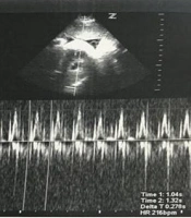 Successful Management of an Atrioventricular Nodal Re-entrant Tachycardia in a Neonate: A Case Report