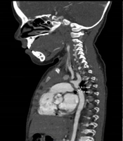 Cerebral Infarction Following Correction of Aortic Coarctation Surgery in Children