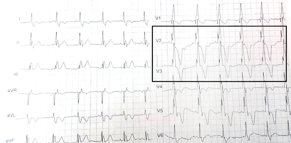 Fragmented QRS in pericardial leads of ECG Fragmented QRS in pericardial leads of ECG