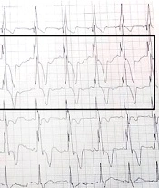 Comparison and Validity of Fragmented QRS (fQRS) Against Cardiac Magnetic Resonance (CMR) in Predicting Right Heart Function in Tetralogy of Fallot Patients After Reconstructive Surgery