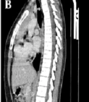A Twelve-Year-Old-Girl with Intra-Tracheal Mucous Gland Adenoma: A Case Report