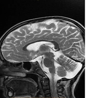 Ifosfamide-Induced Encephalopathy Managed Successfully with Methylene Blue in a Child with Wilms Tumor: A Case Report and Review of the Literature
