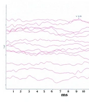 Unilateral Sensorineural Hearing Loss in Johnson-Blizzard Syndrome: A Rare Case Report