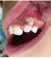 Foreign Bodies Attached to Gingiva in Child Population