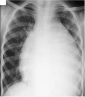The COVID-19 Infection Complicated with Chylopericardium in a Six-Month-Old Boy After Glenn Shunt Surgery; A Rare Phenomenon in the Pediatric